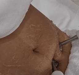 Stretchmarks Removal