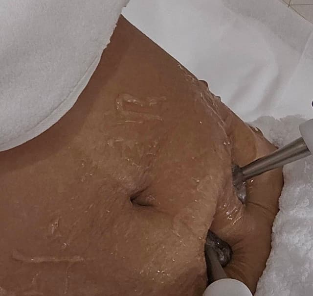 Stretchmarks Removal