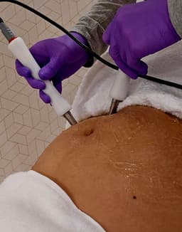 Stretchmarks Removal