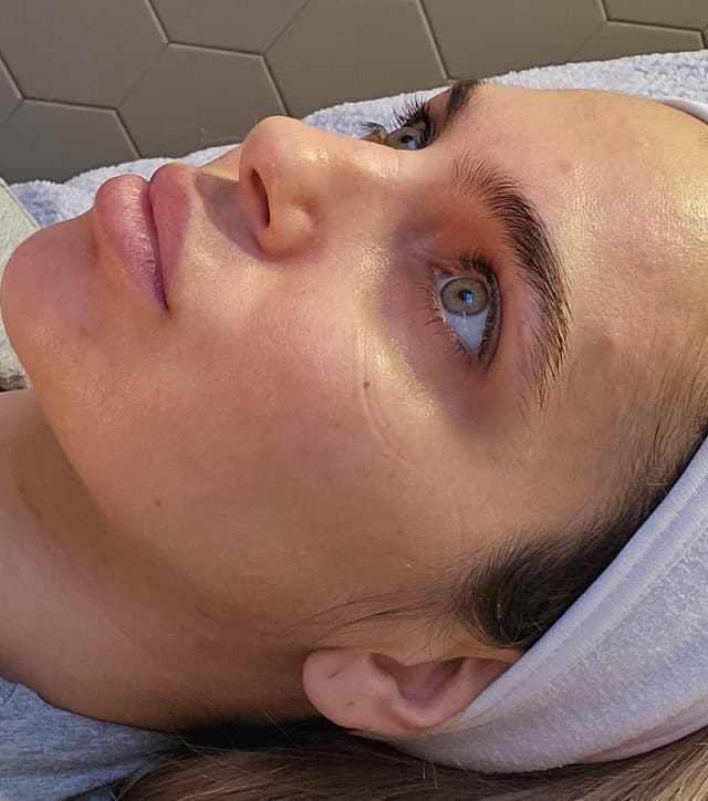 Skin Tightening