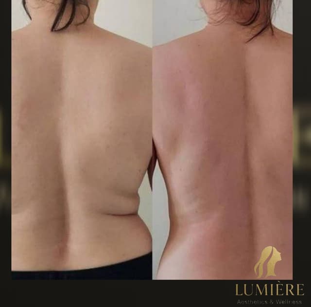 Fat Dissolve Injections