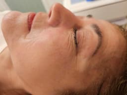 Fractional Radiofrequency