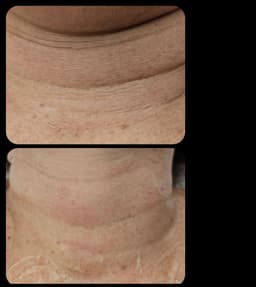 Fractional Radiofrequency