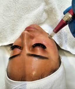 Microneedling