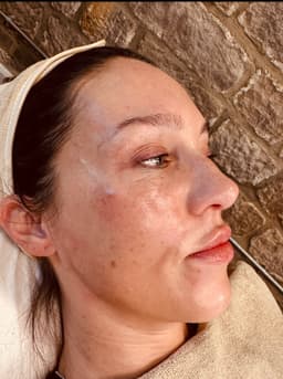 Dermaplane and seventy Hyal combined l