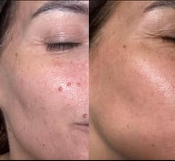 Before & After only one session of microneedling