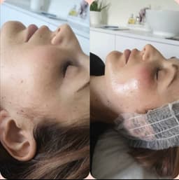 Dermaplane & skin peel combined