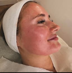 Microneedling glow