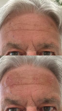 Forehead Filler 