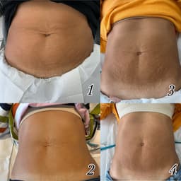 Body Contouring (4 Sessions)