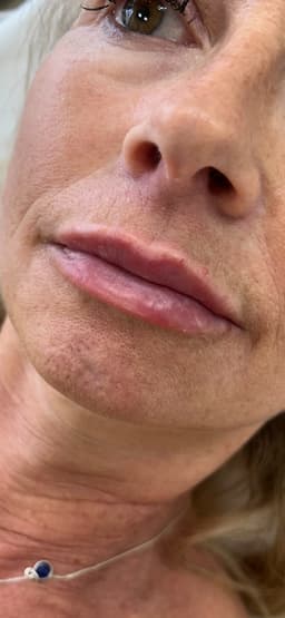 1ml Lip Filler