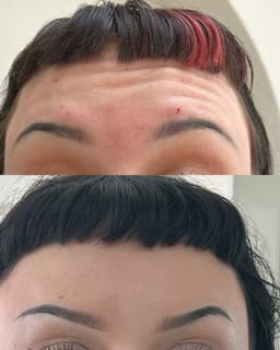 Upper Face Toxin