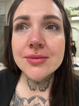 1ml Lip Filler