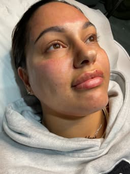 1ml Lip Filler & Microneedling