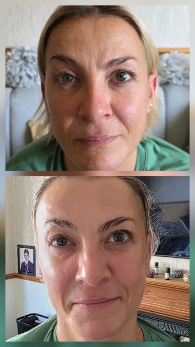 #bespokeantagingfacial