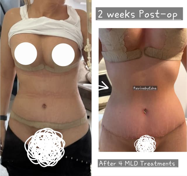 MLD I Manual Lymphatic Drainage Treatment