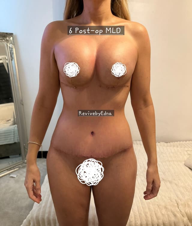 6 Post-op MLD treatment result