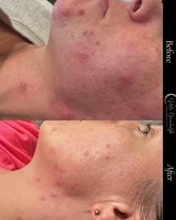 Nimue Thermal Detox Peel results after just a few days
