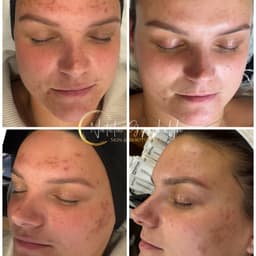 Nimue TS Microneedling just 3 treatments