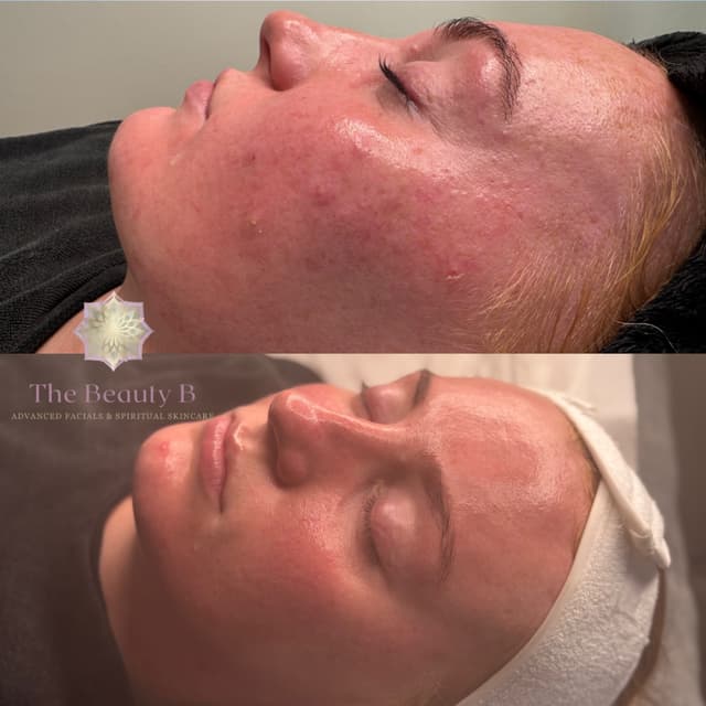 Acne transformation