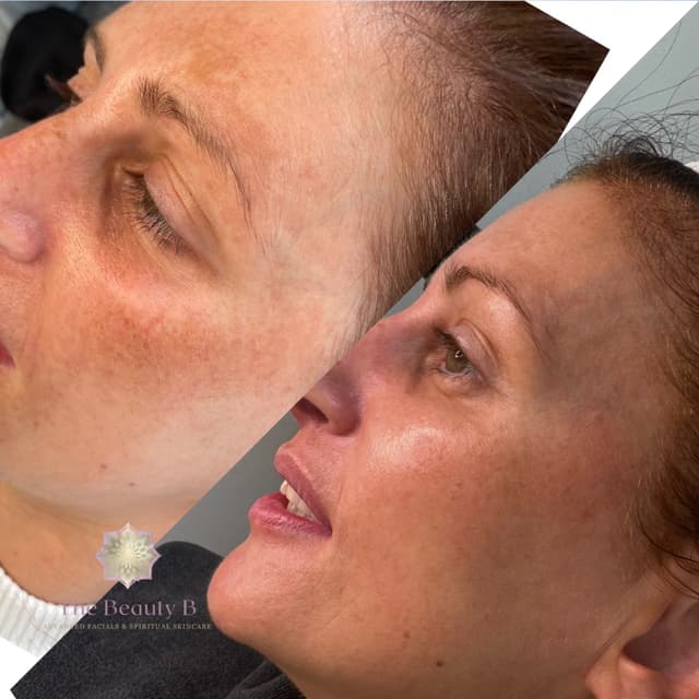 Pigmentation treatment