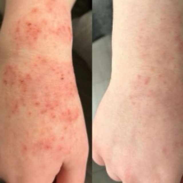 Treating Eczema after 3 sessions with Dr Platon Cold Plasma