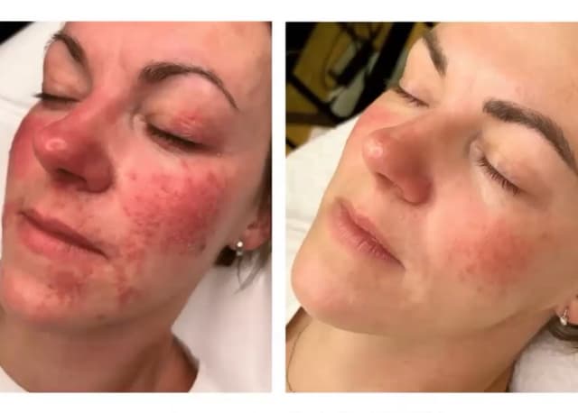Treating Rosacea after seven session with Dr Platon Cold Plasma