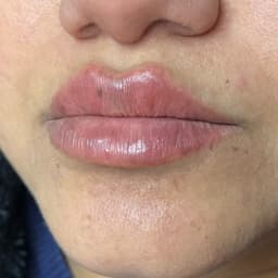 Lip filler