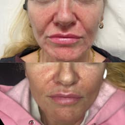 nasolabial folds & smile lines