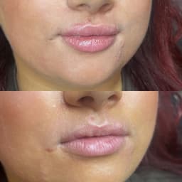 Lip filler