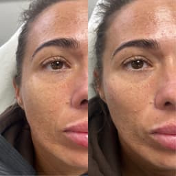 Cheek filler & smile lines