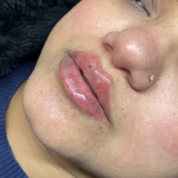 Lip filler