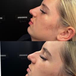 Non surgical rhinoplasty