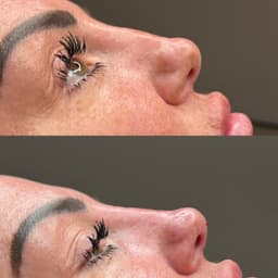 Non surgical rhinoplasty