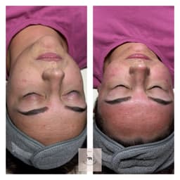 Microneedling facial