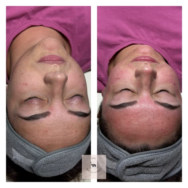 Microneedling facial