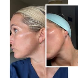 Glow chemical skin peel