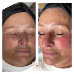 Dermaplane facial with lash tint and brow tint