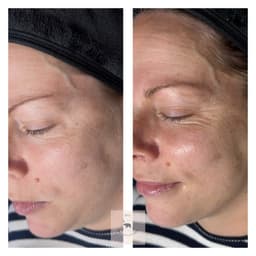 Glow chemical skin peel