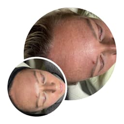 Glow chemical skin peel