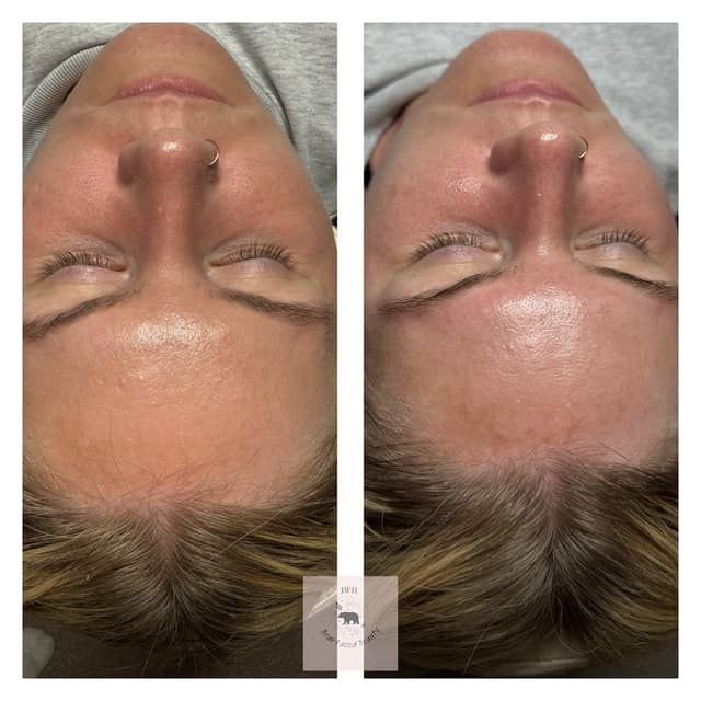 Glow chemical peel