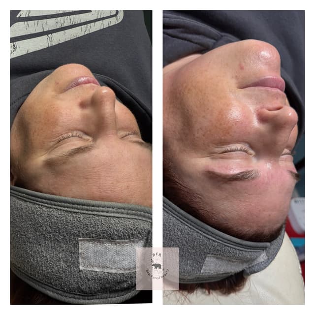 Dermaplane facial with RF and brow tint and tidy