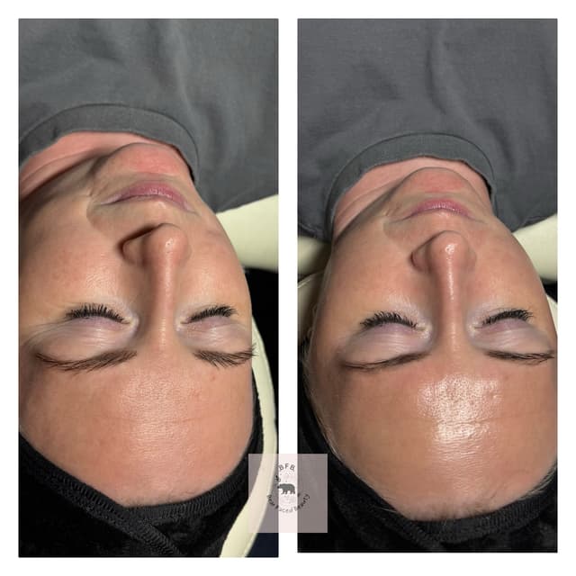 Glow chemical peel