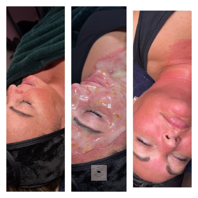 Microneedling face and chest