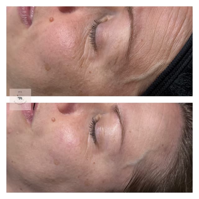 End result of 3x glow peel
