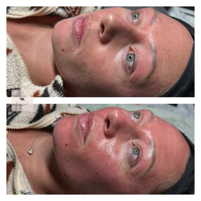 Dermaplane Microneedling + LED