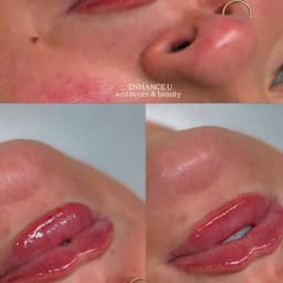 1.1ml lip filler