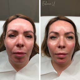 Contouring filler package