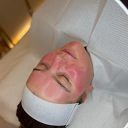 Glass facial - microneedling