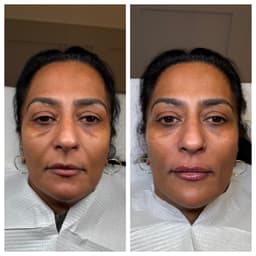Contouring filler package